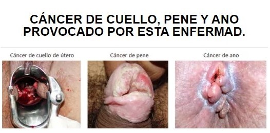 Cánceres avanzados de pene, ano y vagina por VPH no tratado