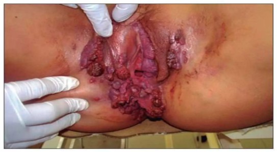 Verrugas en mujeres