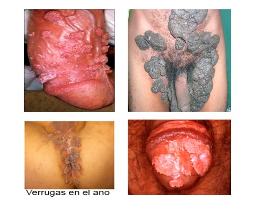 Verrugas en hombres